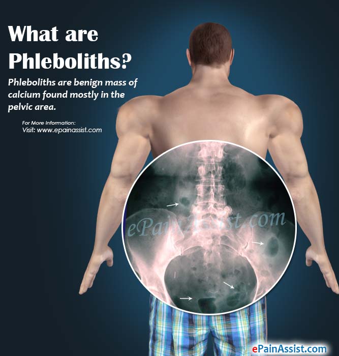 What are Phleboliths?