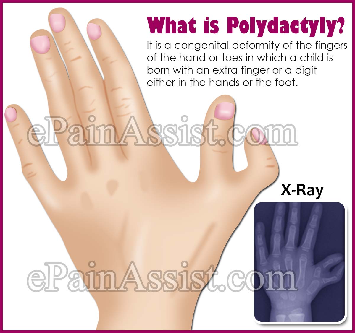 What is Polydactyly? What is Polydactyly?