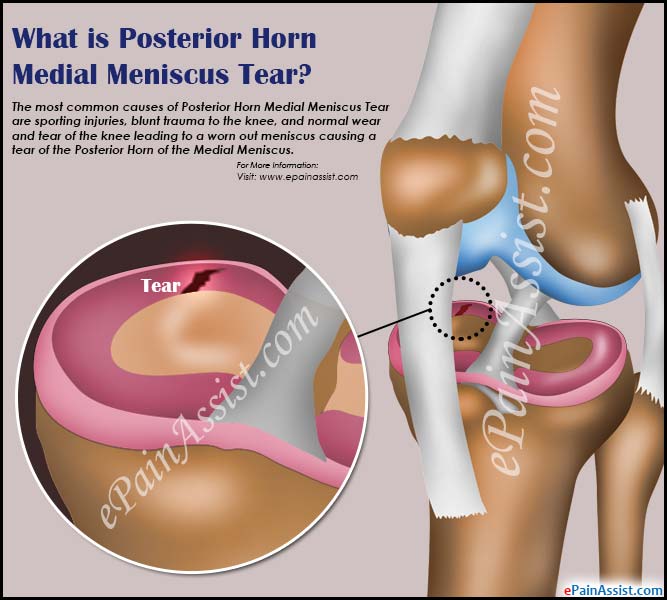 What is Posterior Horn Medial Meniscus Tear?