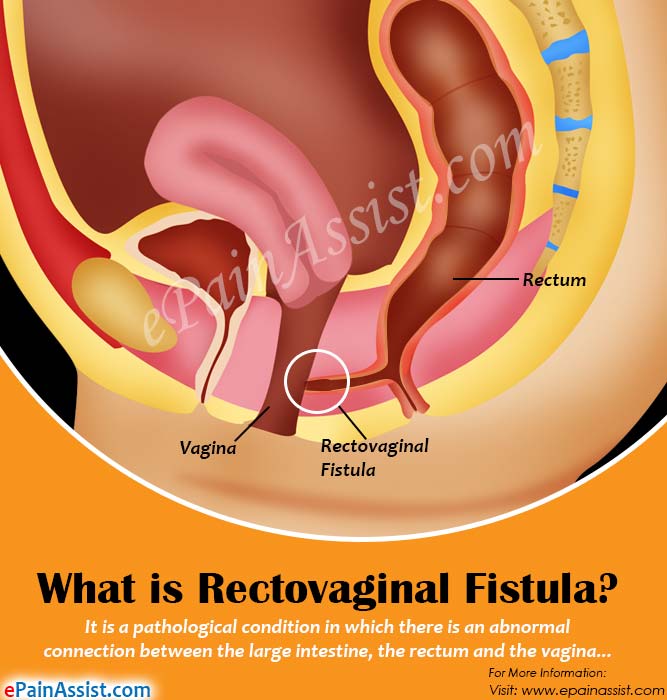 What is Rectovaginal Fistula?