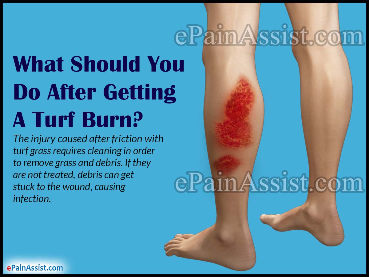 What Should You do After Getting a Turf Burn?