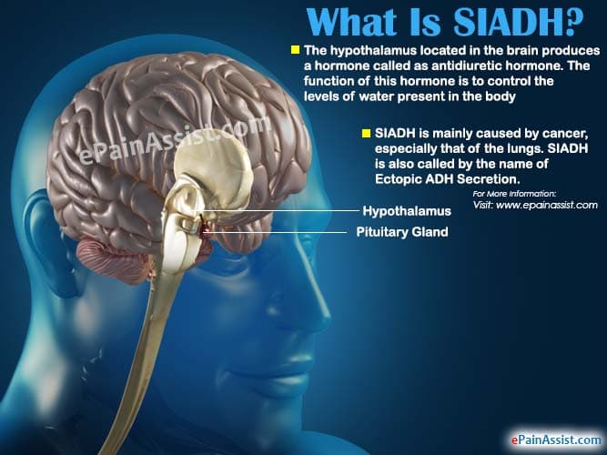 What Is SIADH Or Syndrome Of Inappropriate Antidiuretic Hormone? What Is SIADH Or Syndrome Of Inappropriate Antidiuretic Hormone?
