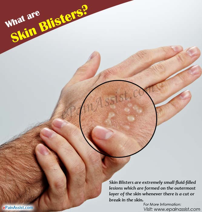 What causes skin blisters?