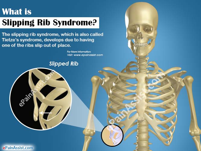 What is Slipping Rib Syndrome?