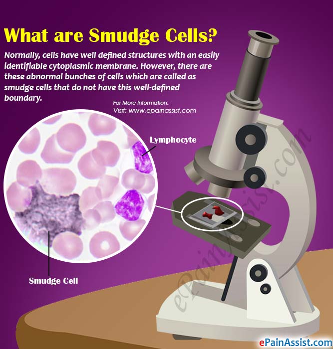 What are Smudge Cells