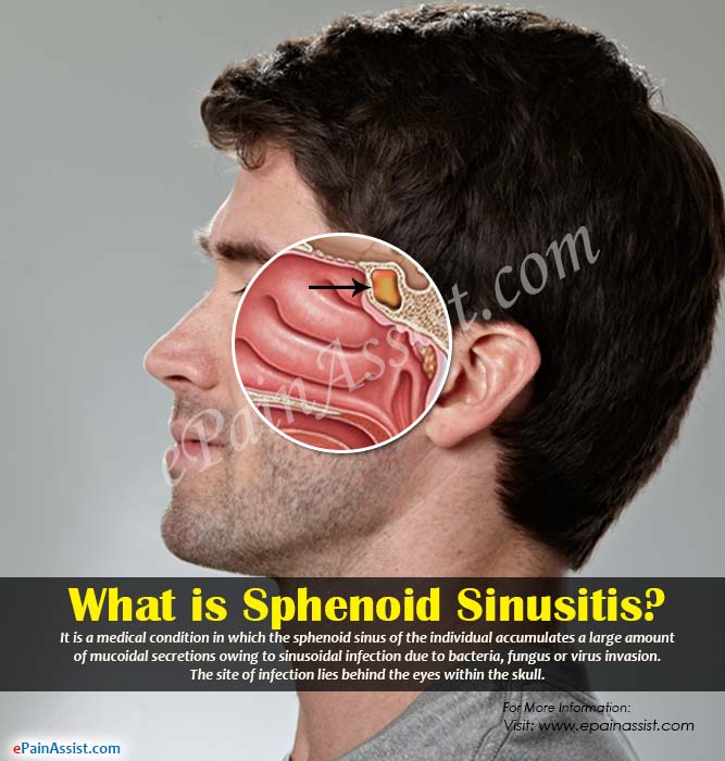 What is Sphenoid Sinusitis?