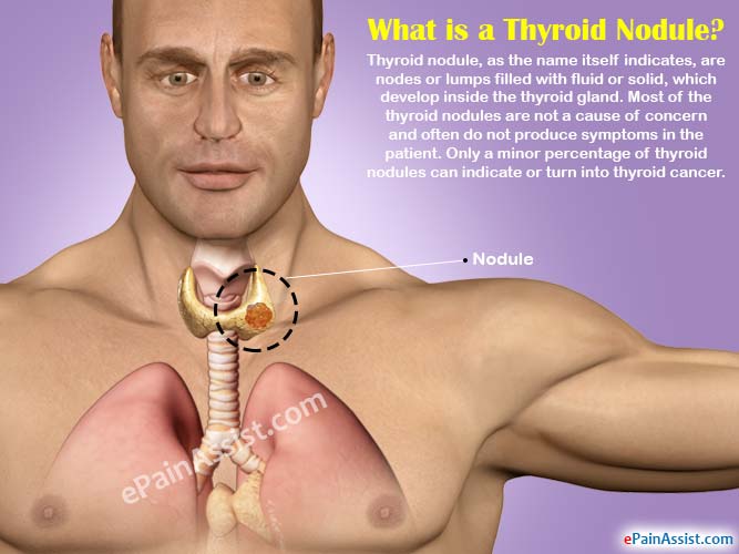 What is a Thyroid Nodule?