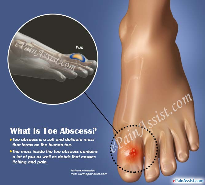 What Is Toe Abscess Causes Symptoms Treatment Home Remedies