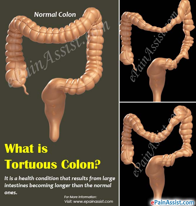 What is Tortuous Colon?