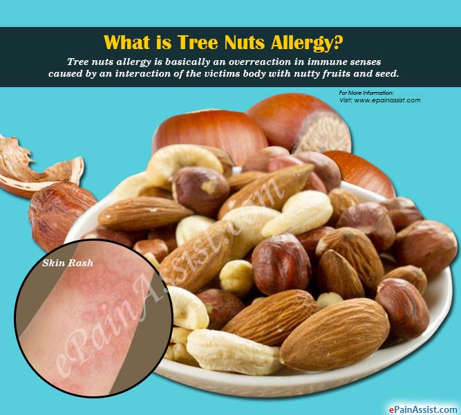 What is Tree Nuts Allergy?