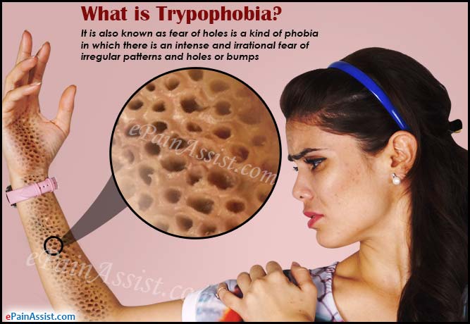 Trypophobia Or Fear Of Holes Causes Symptoms Diagnosis Treatment 