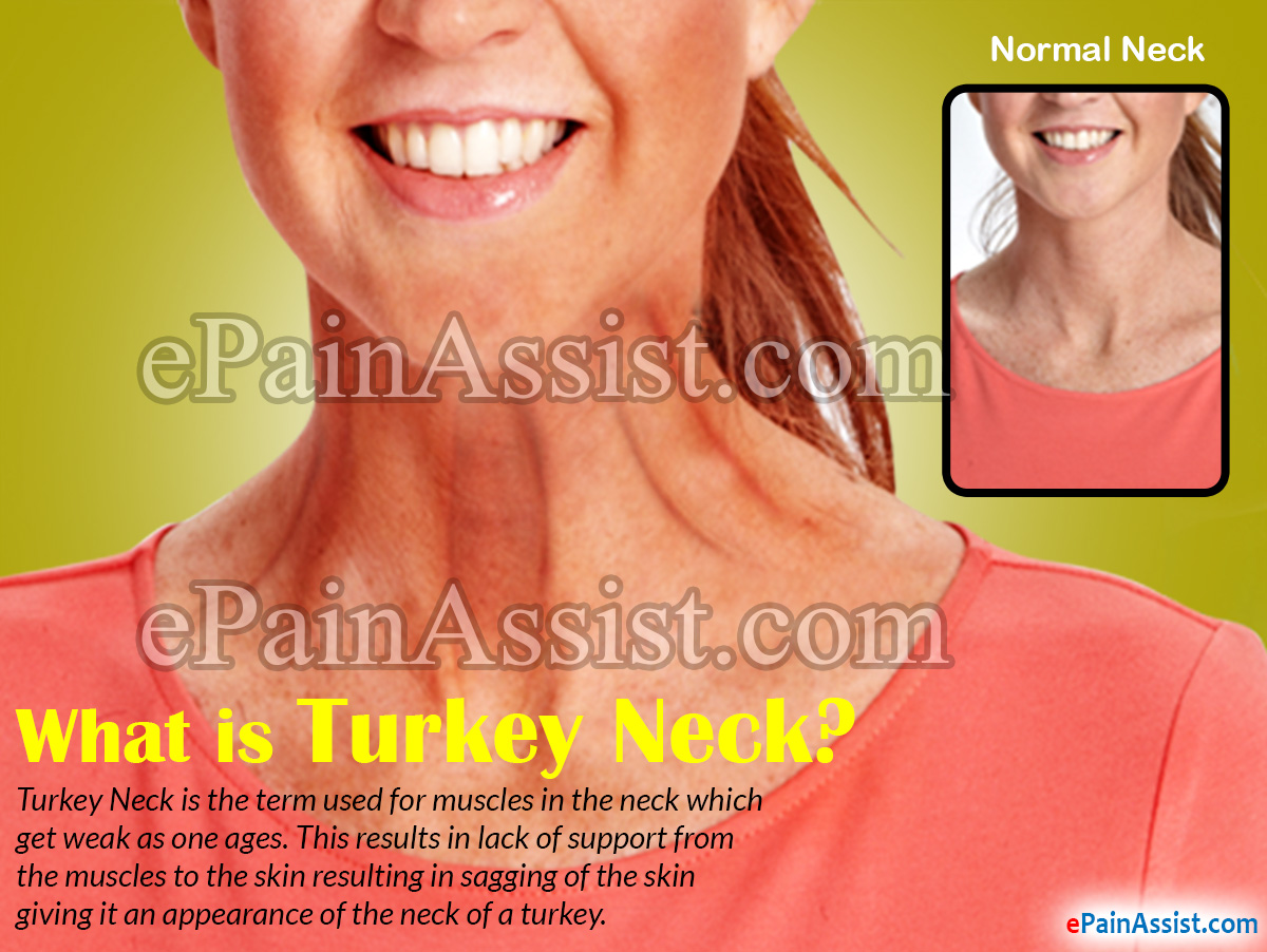 What is Turkey Neck?