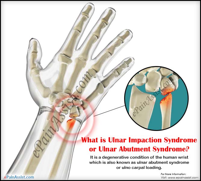 What is Ulnar Impaction Syndrome or Ulnar Abutment Syndrome?