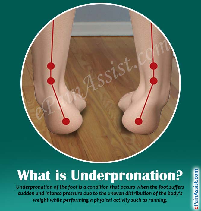 underpronation and flat feet