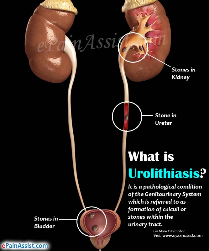 Urolithiasis adalah