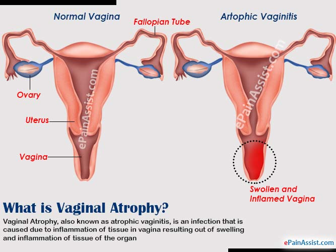 What Causes Vaginal Atrophy And How To Overcome It 