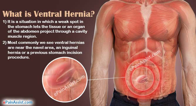 What is Ventral Hernia?