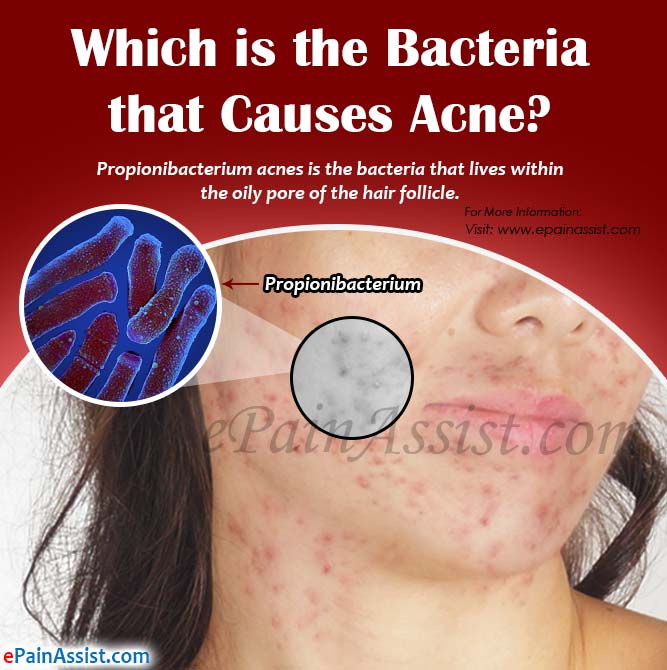 Which is the Bacteria that Causes Acne? Which is the Bacteria that Causes Acne?