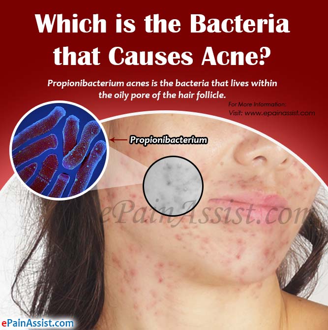 Which is the Bacteria that Causes Acne?